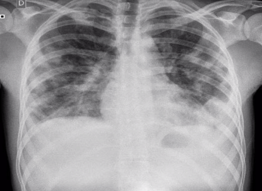 Pneumonia por Staphylococcus aureus resistente à meticilina comunitário ...